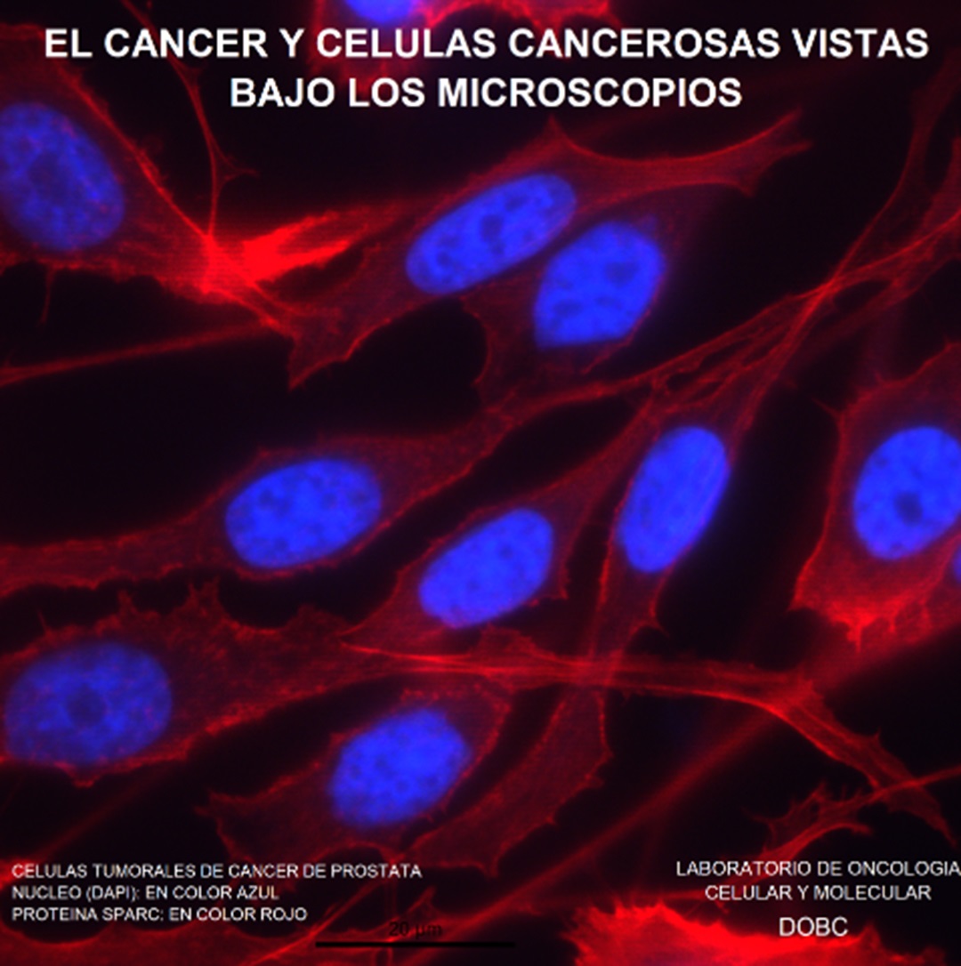 El cáncer y células cancerosas vistas bajo los microscopios